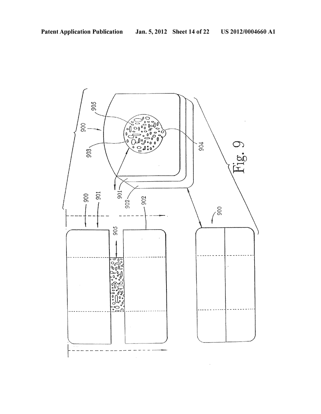 Multi-component cortical bone assembled implant - diagram, schematic, and image 15