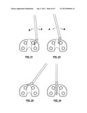 MEDICAL IMPLANT EXTRACTION DEVICE diagram and image