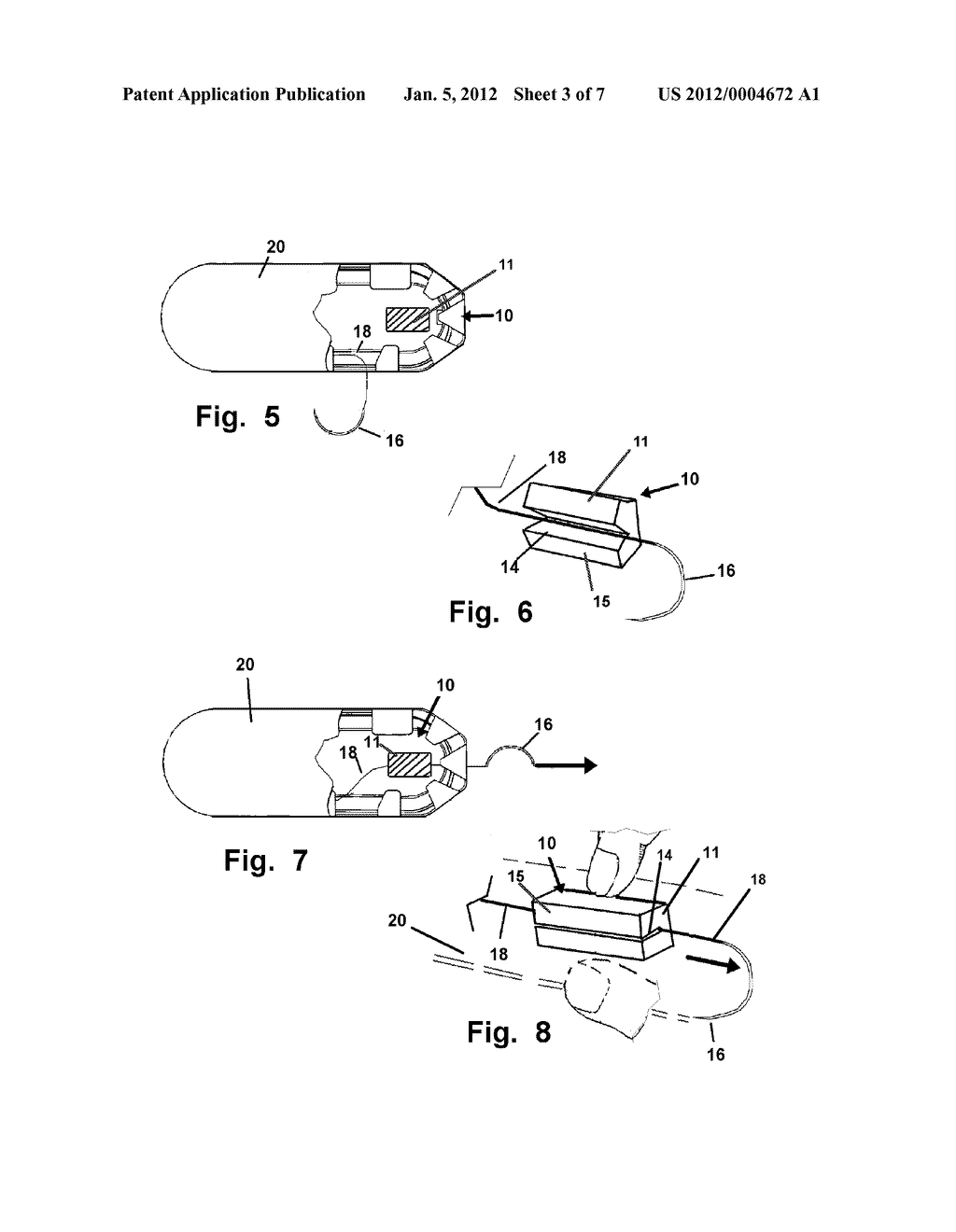 Suture Straightening Device and Method - diagram, schematic, and image 04