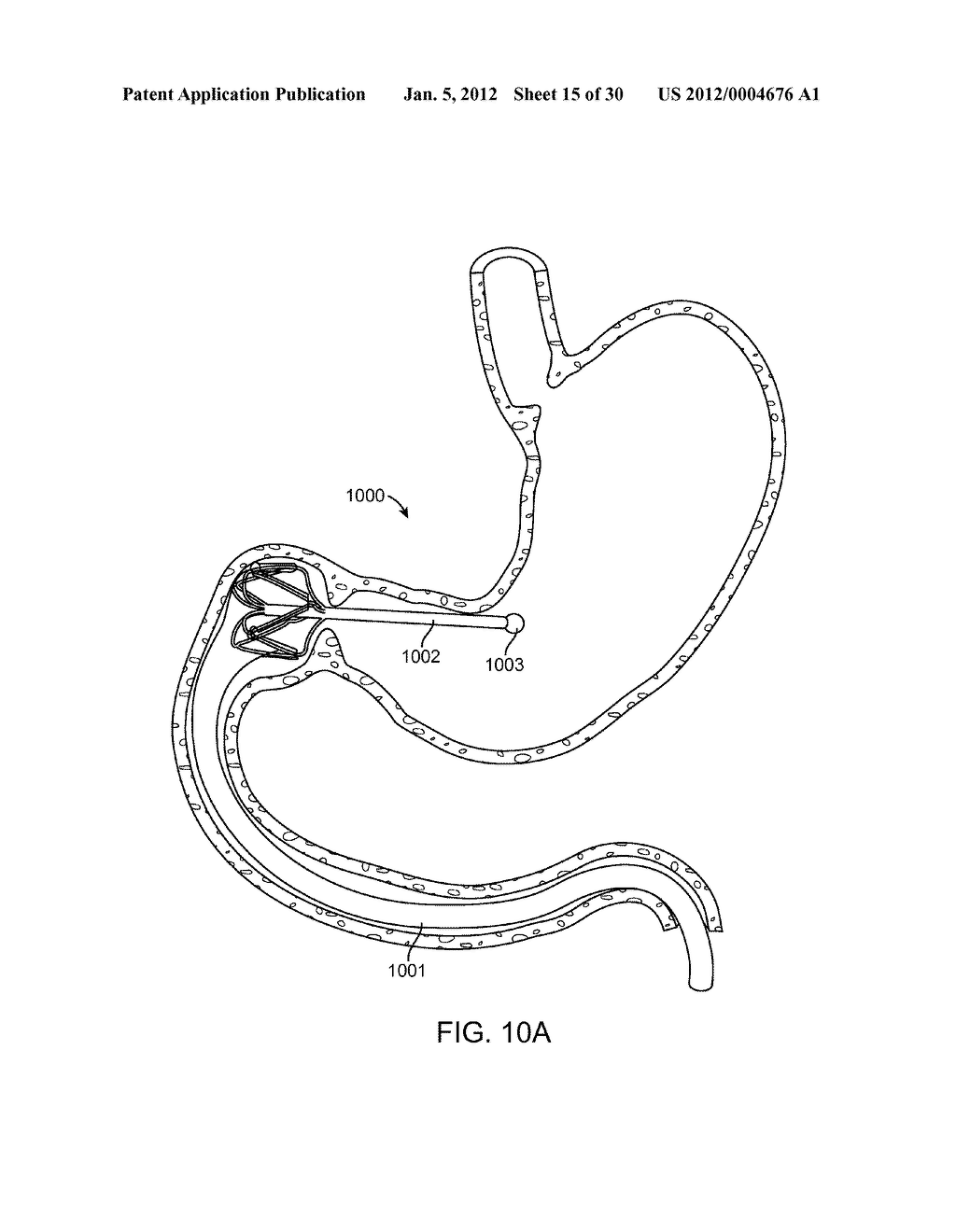Intragastric Implant Devices - diagram, schematic, and image 16