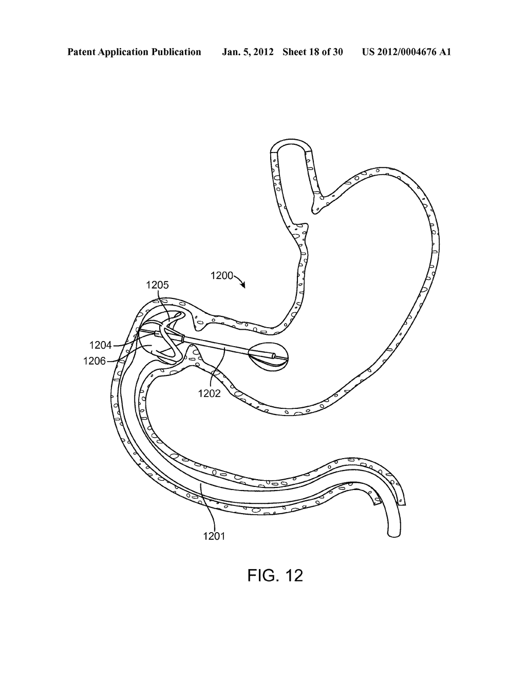 Intragastric Implant Devices - diagram, schematic, and image 19