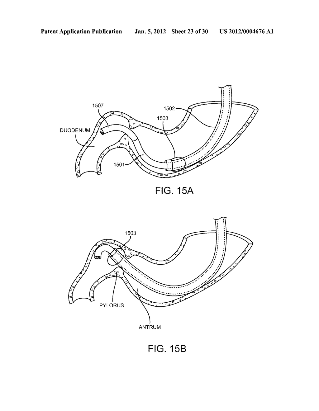 Intragastric Implant Devices - diagram, schematic, and image 24