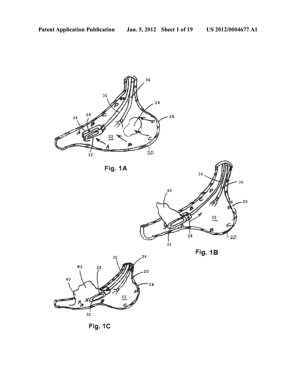 TISSUE-ACQUISITION AND FASTENING DEVICES AND METHODS - diagram, schematic, and image 02