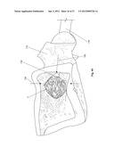 EXPANDABLE SUPPORT DEVICE AND METHOD OF USE diagram and image