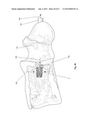 EXPANDABLE SUPPORT DEVICE AND METHOD OF USE diagram and image