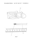 EXPANDABLE SUPPORT DEVICE AND METHOD OF USE diagram and image