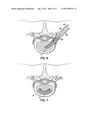 DEPLOYABLE SEGMENTED TLIF DEVICE diagram and image