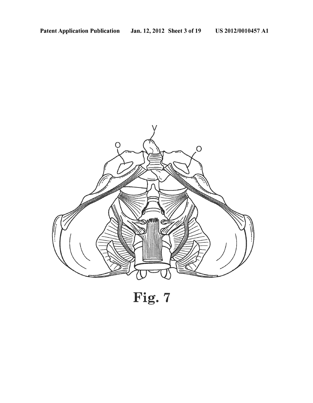 Prolapse Repair - diagram, schematic, and image 04