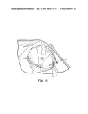 Prolapse Repair diagram and image