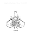 Prolapse Repair diagram and image