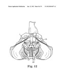 Prolapse Repair diagram and image