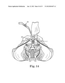 Prolapse Repair diagram and image