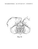 Prolapse Repair diagram and image