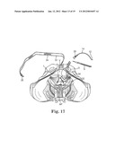 Prolapse Repair diagram and image