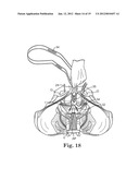 Prolapse Repair diagram and image