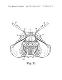 Prolapse Repair diagram and image