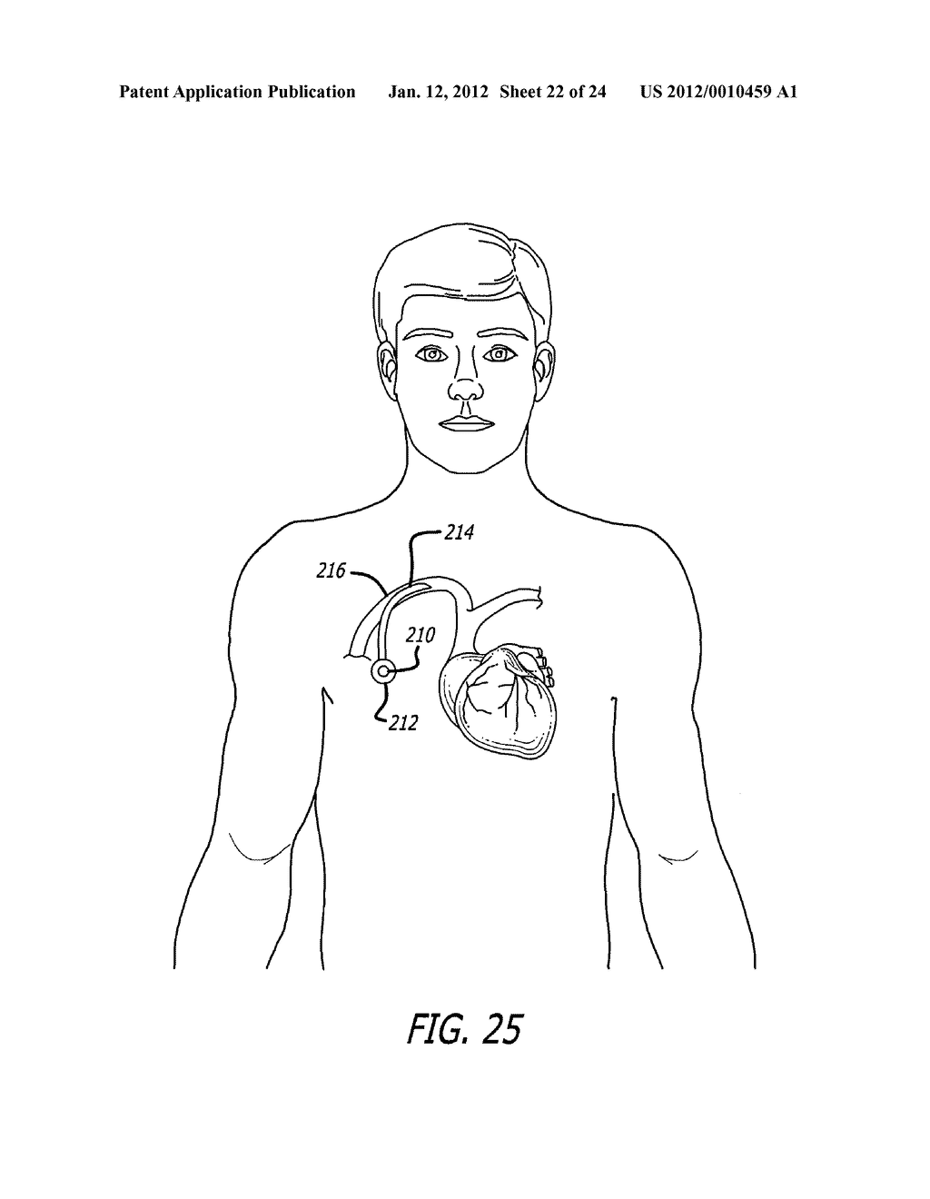 ASSEMBLY AND METHOD FOR AUTOMATICALLY CONTROLLING PRESSURE FOR A GASTRIC     BAND - diagram, schematic, and image 23