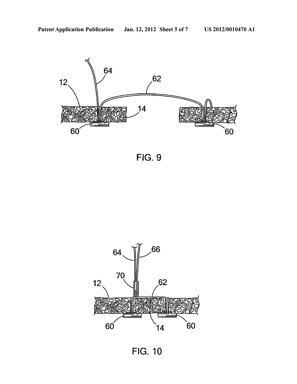 DEVICES AND METHODS FOR ANCHORING A TUBE - diagram, schematic, and image 06