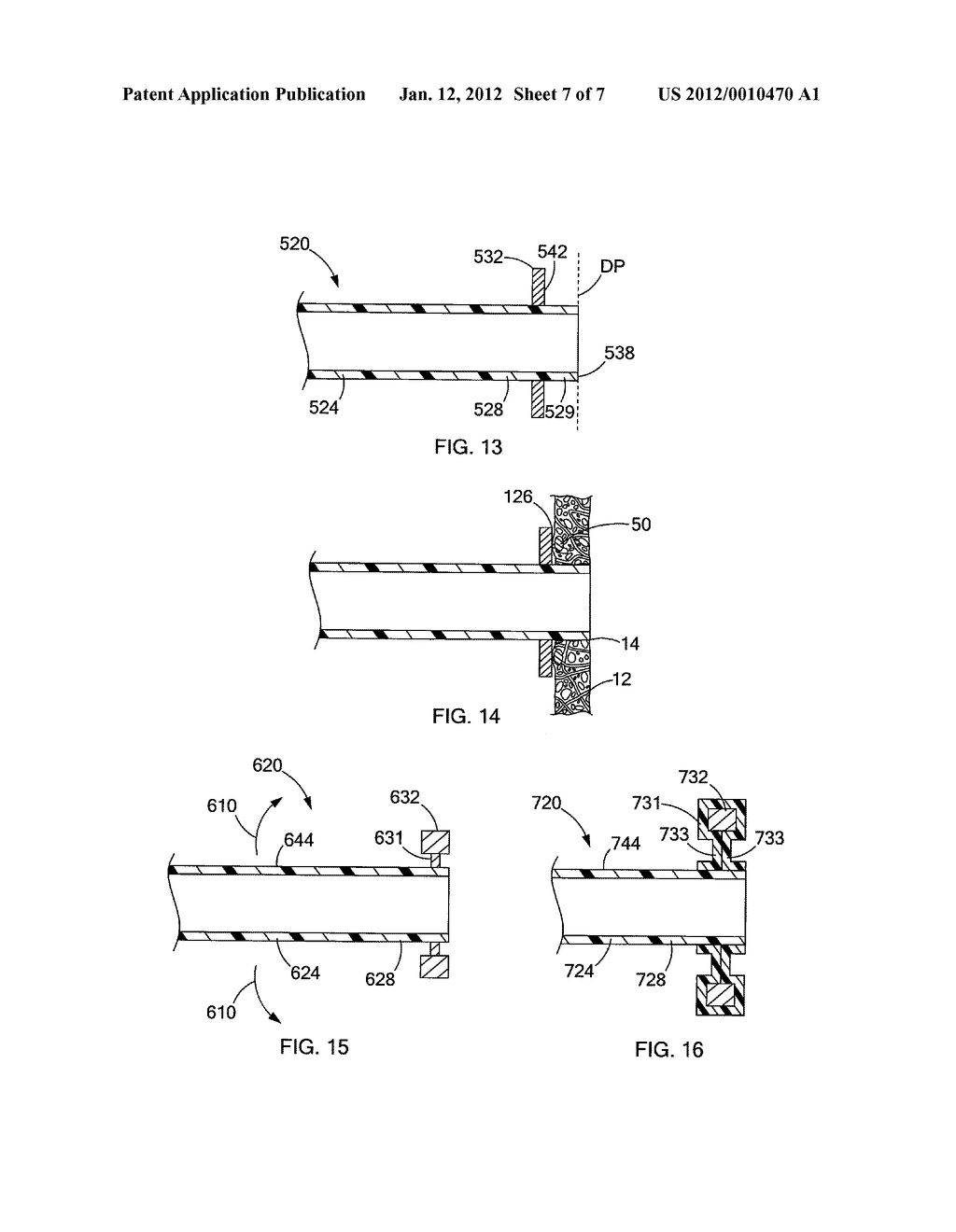 DEVICES AND METHODS FOR ANCHORING A TUBE - diagram, schematic, and image 08