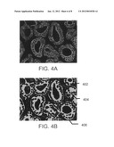 Systems and methods for predicting disease progression in patients treated     with radiotherapy diagram and image