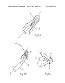 IMPROVED ULTRASONIC SURGICAL TOOL diagram and image