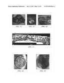 SYSTEM FOR PERCUTANEOUSLY ADMINISTERING REDUCED PRESSURE TREATMENT USING     BALLOON DISSECTION diagram and image