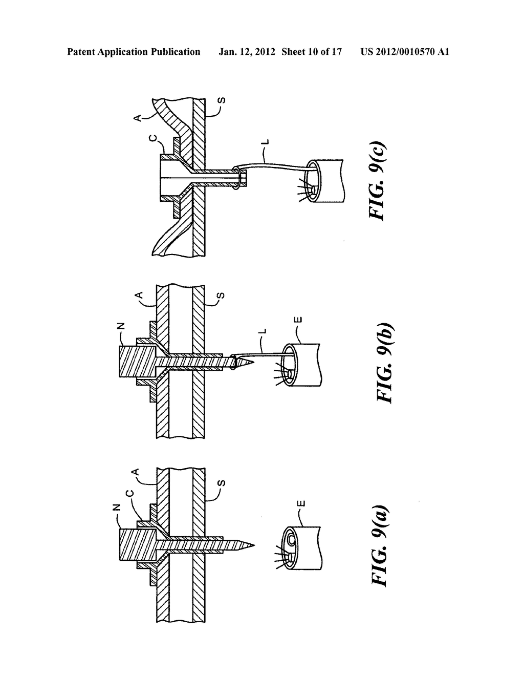 METHOD FOR PERCUTANEOUSLY IMPLANTING A MEDICAL CATHETER AND MEDICAL     CATHETER IMPLANTING ASSEMBLY - diagram, schematic, and image 11