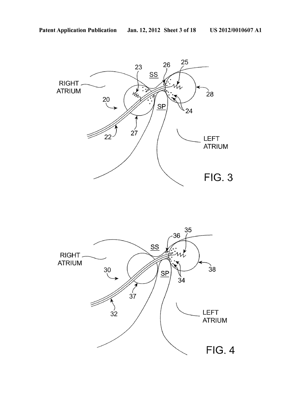 ENERGY BASED DEVICES AND METHODS FOR TREATMENT OF PATENT FORAMEN OVALE - diagram, schematic, and image 04