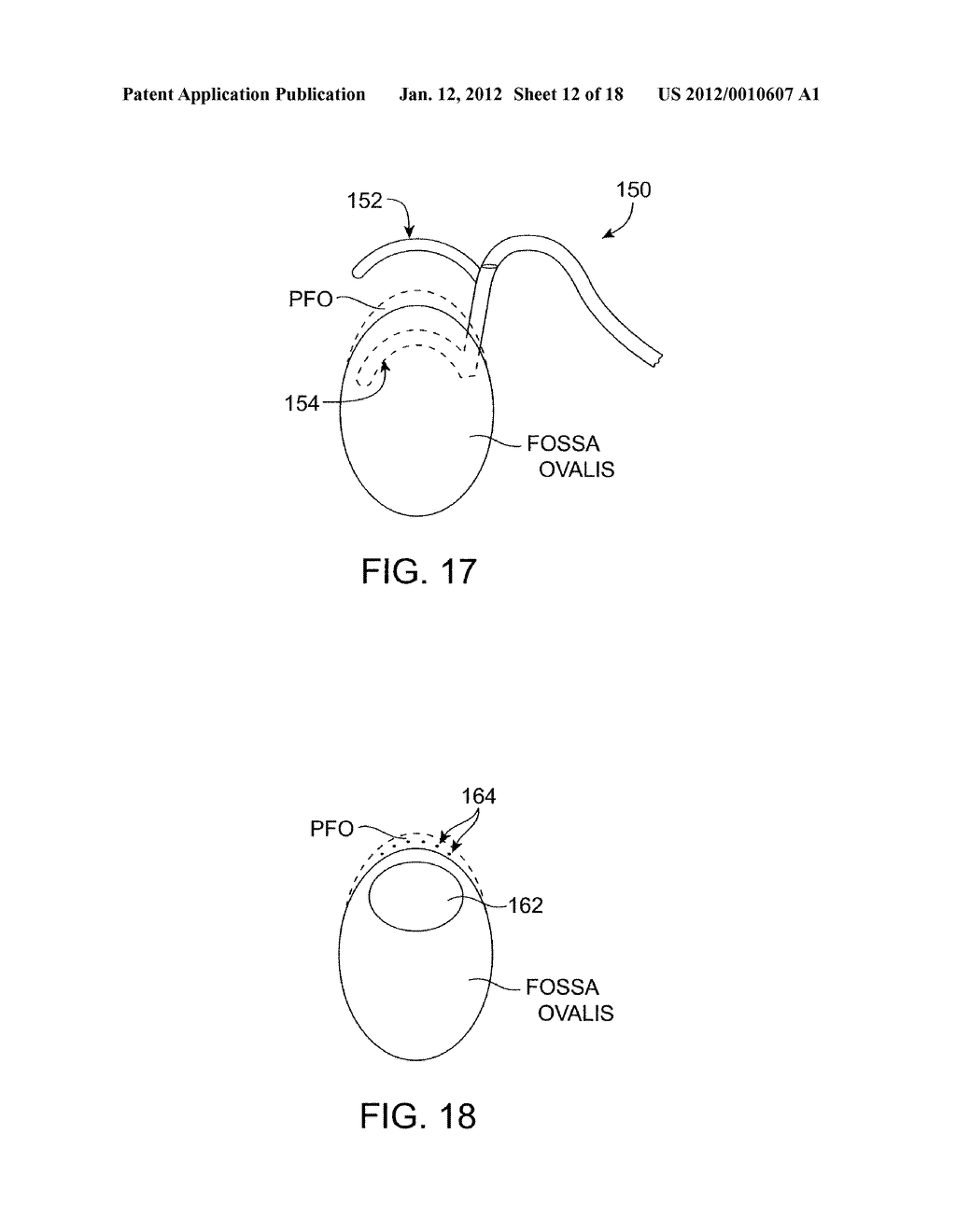 ENERGY BASED DEVICES AND METHODS FOR TREATMENT OF PATENT FORAMEN OVALE - diagram, schematic, and image 13