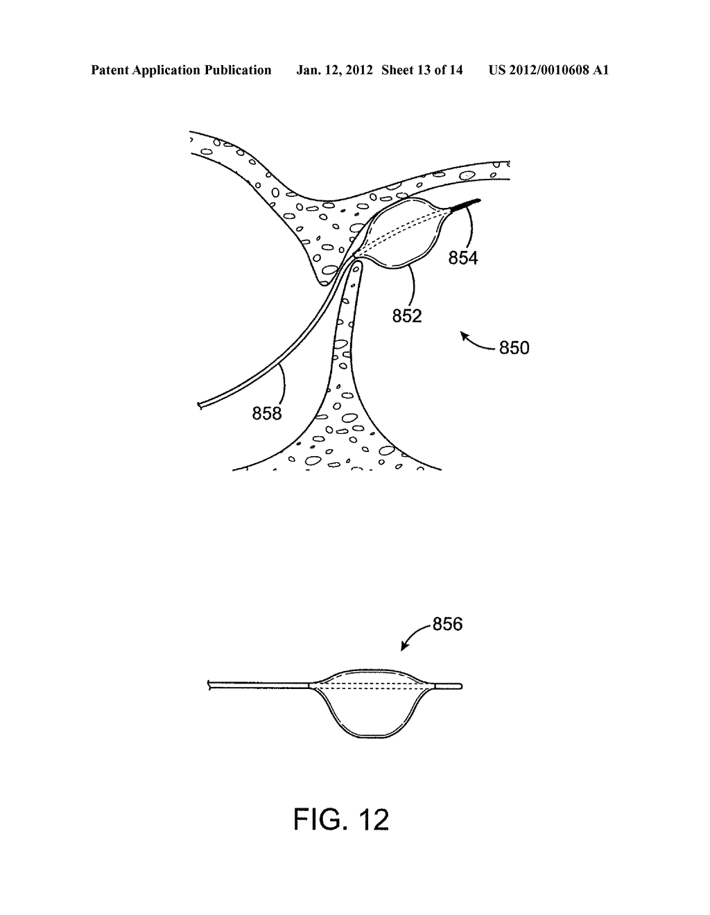 ENERGY BASED DEVICES AND METHODS FOR TREATMENT OF PATENT FORAMEN OVALE - diagram, schematic, and image 14
