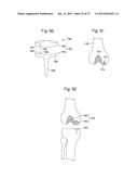 CANNULATED SYSTEMS diagram and image