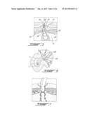 AUTO-GRAFT BIO-SYNTHETIC MESH FOR VENTRAL AND PARASTOMAL HERNIA REPAIR AND     METHOD OF ATTACHMENT diagram and image