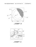 AUTO-GRAFT BIO-SYNTHETIC MESH FOR VENTRAL AND PARASTOMAL HERNIA REPAIR AND     METHOD OF ATTACHMENT diagram and image