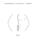 METHODS AND DEVICES FOR URETHRAL TREATMENT diagram and image