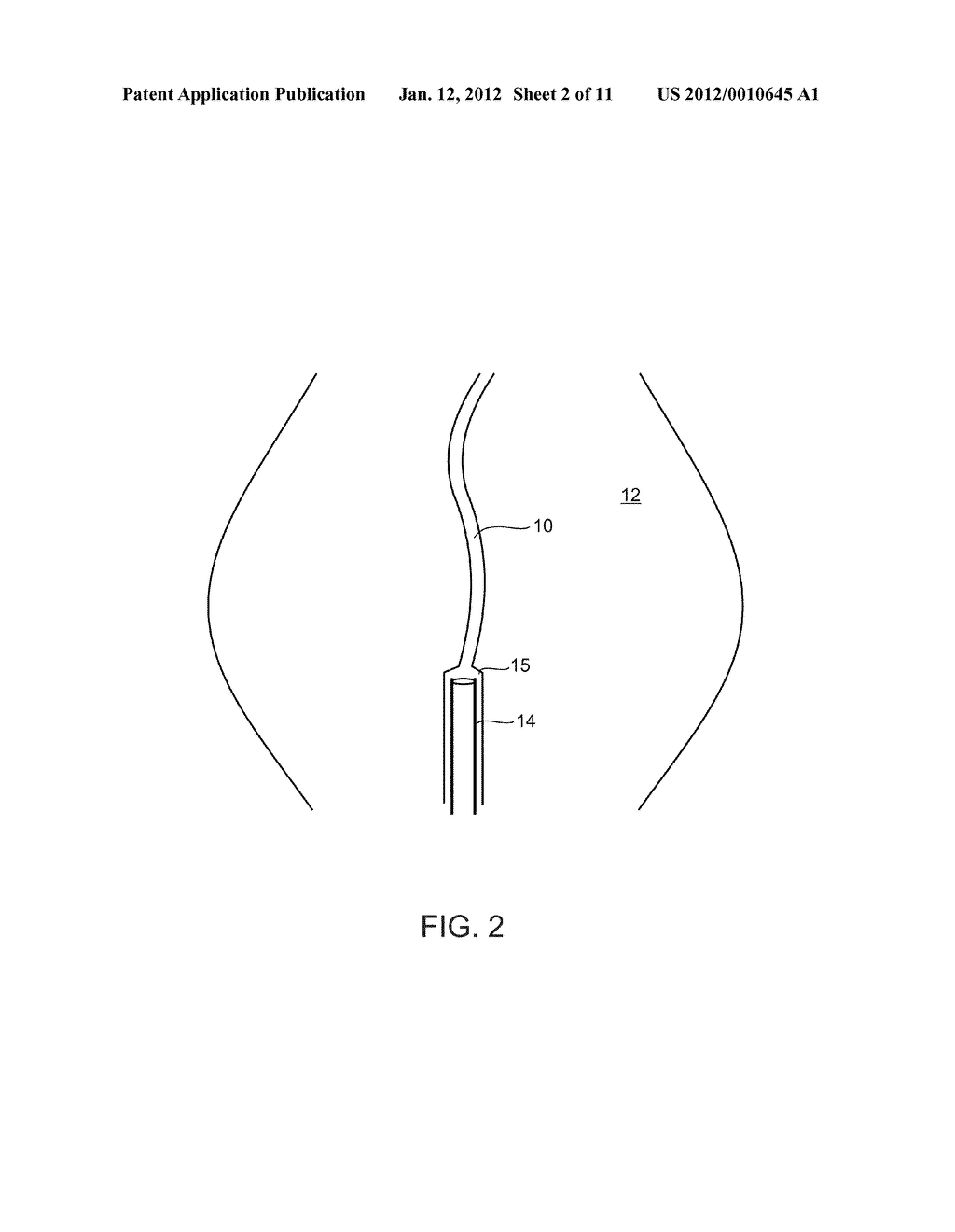 METHODS AND DEVICES FOR URETHRAL TREATMENT - diagram, schematic, and image 03