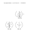 METHODS AND DEVICES FOR URETHRAL TREATMENT diagram and image