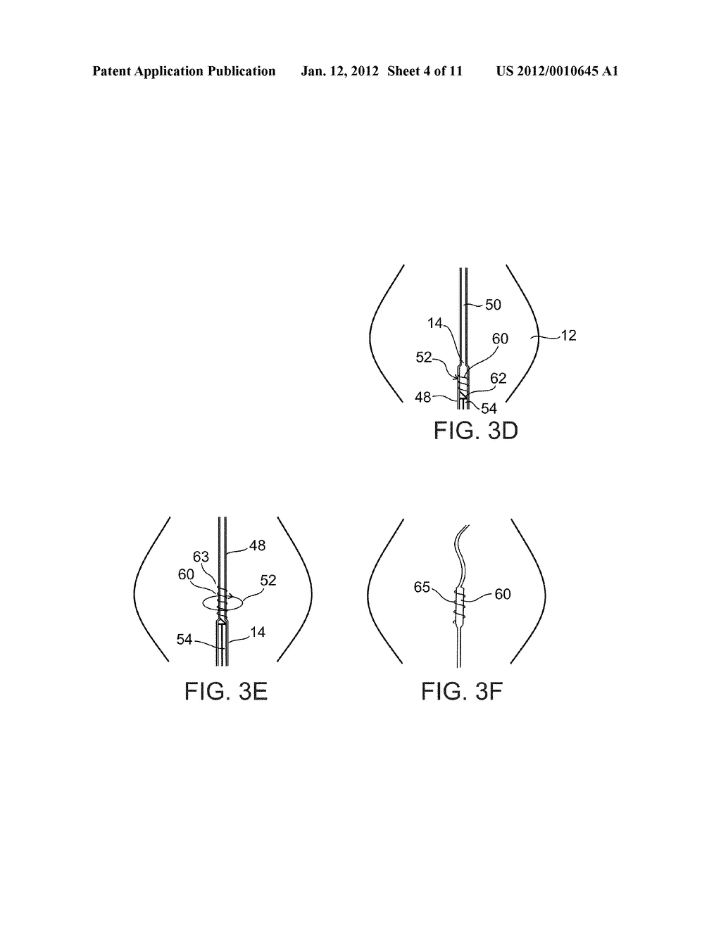 METHODS AND DEVICES FOR URETHRAL TREATMENT - diagram, schematic, and image 05