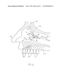 APPARATUS AND METHOD FOR TREATMENT OF SINUSITIS diagram and image