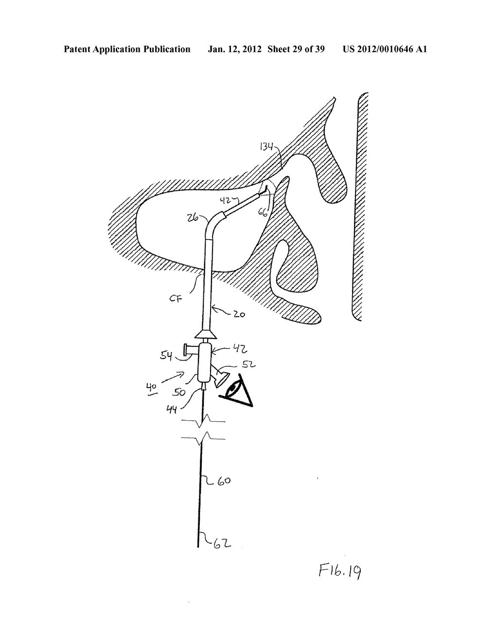APPARATUS AND METHOD FOR TREATMENT OF SINUSITIS - diagram, schematic, and image 30