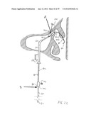 APPARATUS AND METHOD FOR TREATMENT OF SINUSITIS diagram and image