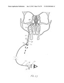 APPARATUS AND METHOD FOR TREATMENT OF SINUSITIS diagram and image