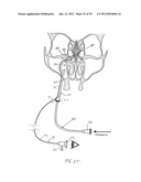 APPARATUS AND METHOD FOR TREATMENT OF SINUSITIS diagram and image