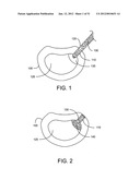 Soft Tissue Repair System diagram and image