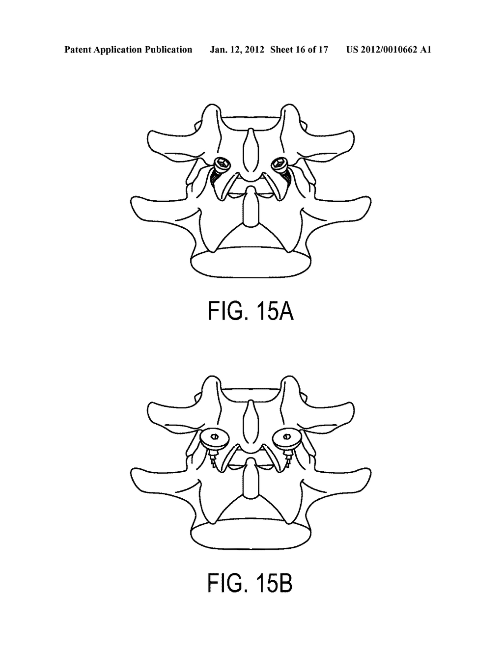 PEDICULAR FACET FUSION SCREW WITH PLATE - diagram, schematic, and image 17