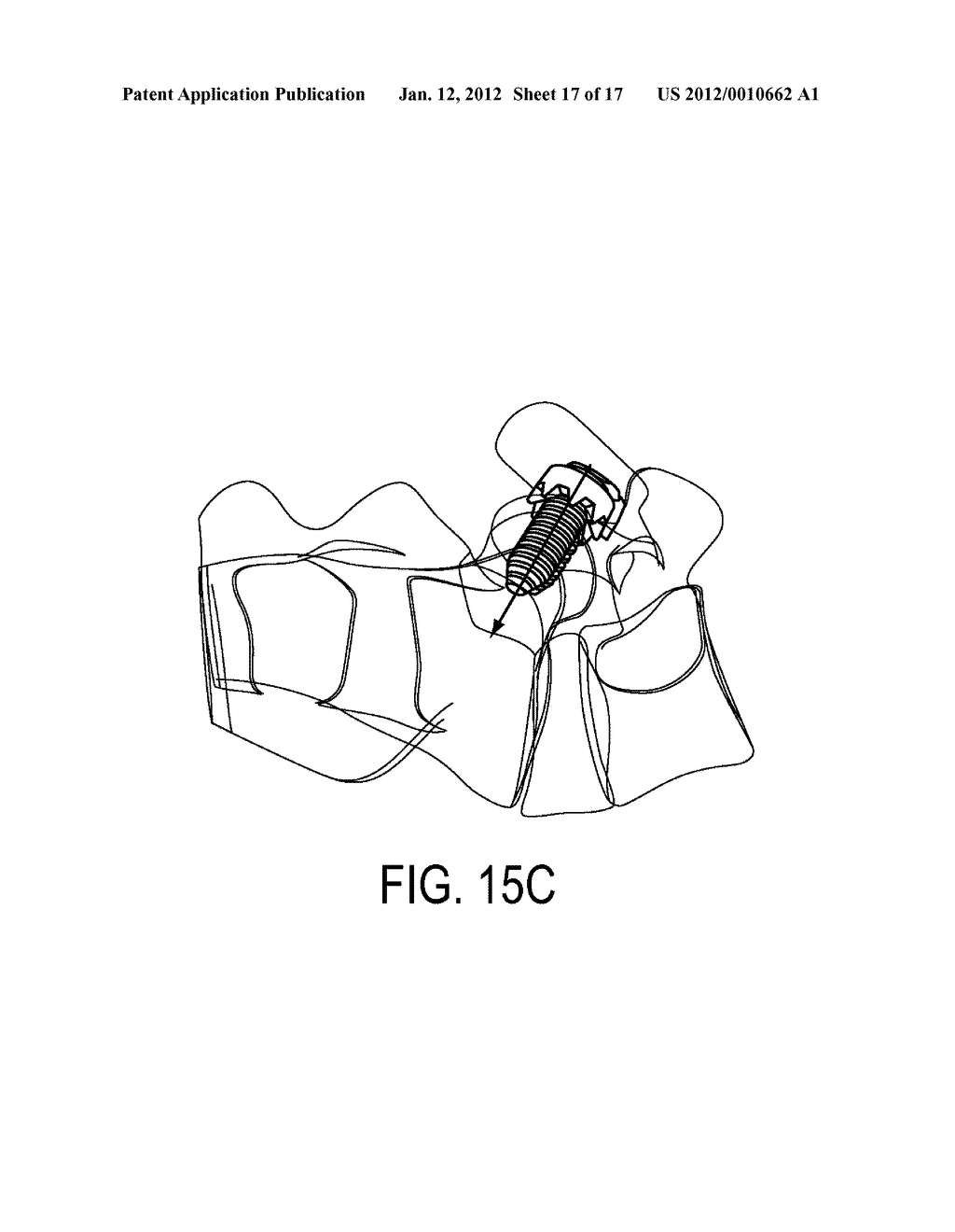 PEDICULAR FACET FUSION SCREW WITH PLATE - diagram, schematic, and image 18