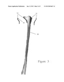 FRACTURE-SPECIFIC DISTAL RADIUS PLATES diagram and image