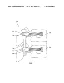 EXPANDABLE SURGICAL IMPLANT diagram and image