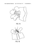 PEDICULAR FACET FUSION SCREW WITH PLATE diagram and image