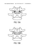 PEDICULAR FACET FUSION SCREW WITH PLATE diagram and image