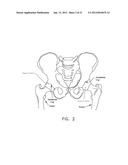 METHOD AND APPARATUS FOR ACCESSING THE INTERIOR OF A HIP JOINT, INCLUDING     THE PROVISION AND USE OF A NOVEL INFLOW ACCESS CANNULA diagram and image